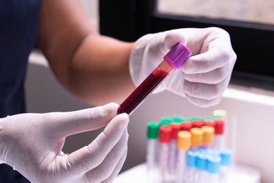 beta-amyloid plaques|Blood test can predict presence of beta.